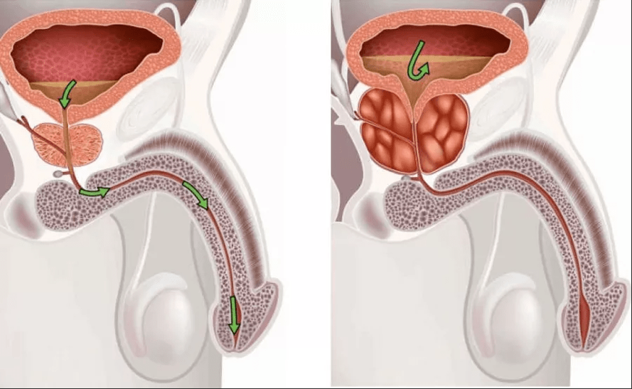 Symptomer vun Prostatitis
